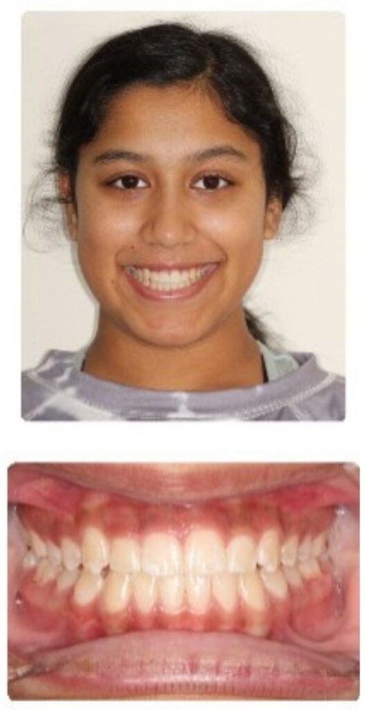 Before and after orthodontic treatment results at Advanced Orthodontics in Mercer Island, Washington