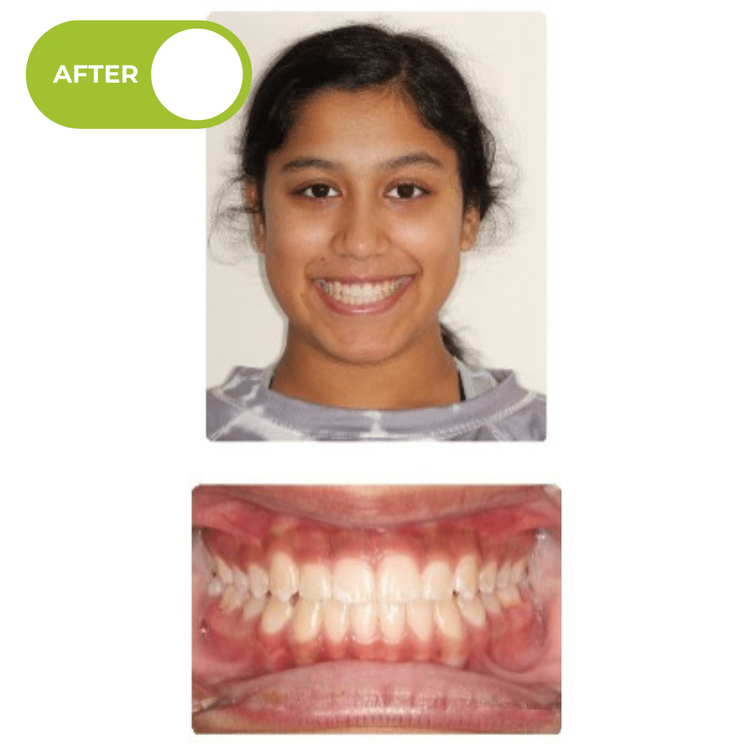 After orthodontic treatment showing improved jaw alignment, corrected bite, and a broader, more even smile following palatal expansion and Invisalign aligner treatment. Advanced Orthodontics Mercer Island, located in Mercer Island, WA 98040.