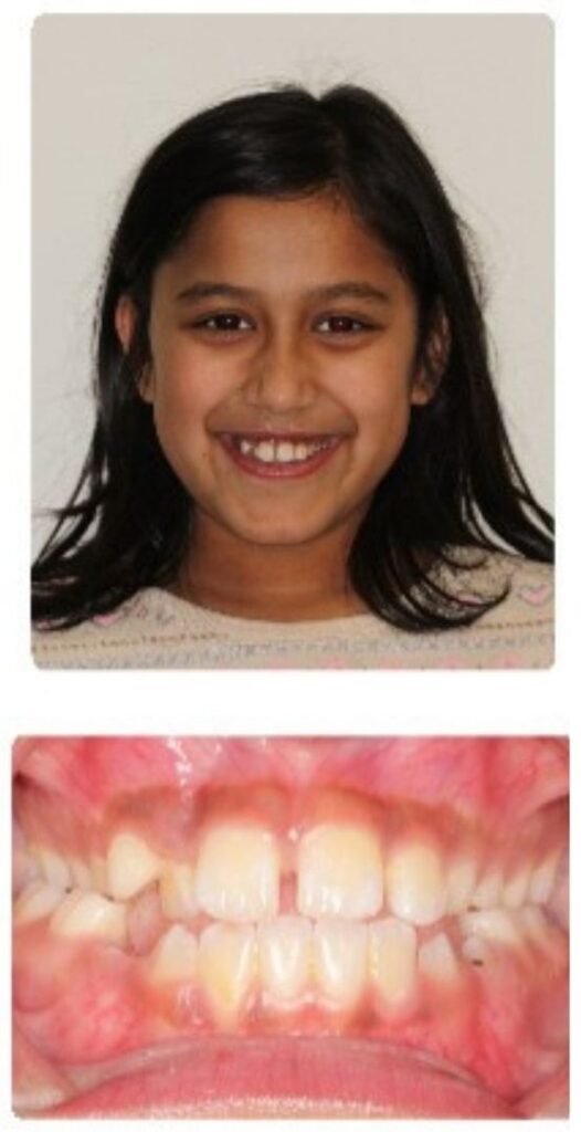 Before and after orthodontic treatment results at Advanced Orthodontics in Mercer Island, Washington