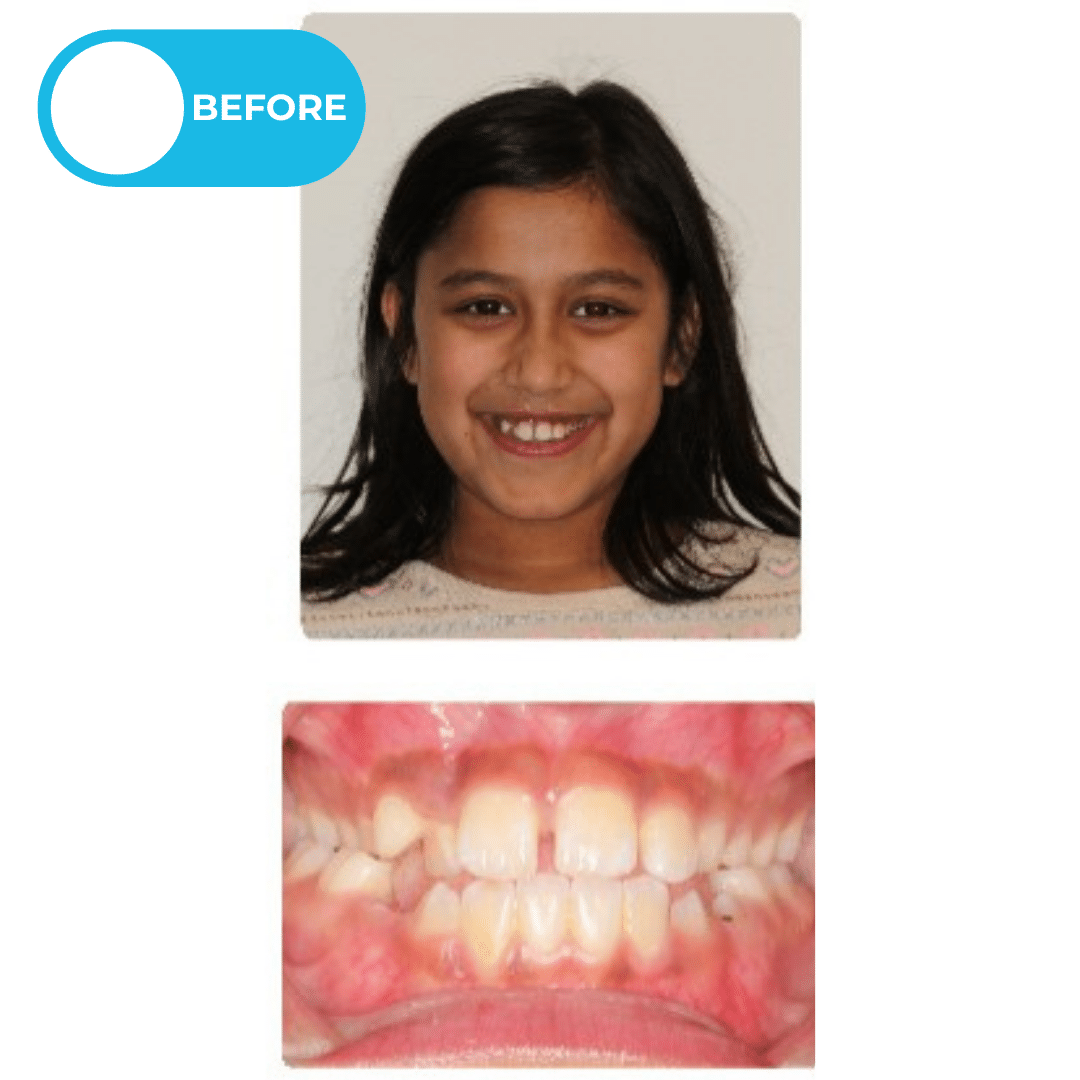 Before orthodontic treatment showing a patient with a narrow upper jaw, underbite, and dental crowding before palatal expansion and Invisalign aligner treatment. Advanced Orthodontics Mercer Island, located in Mercer Island, WA 98040.