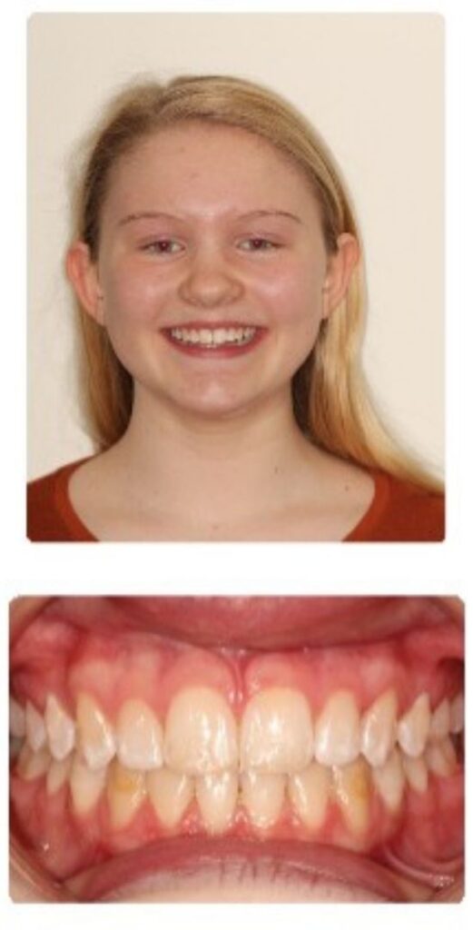 Before and after orthodontic treatment results at Advanced Orthodontics in Mercer Island, Washington
