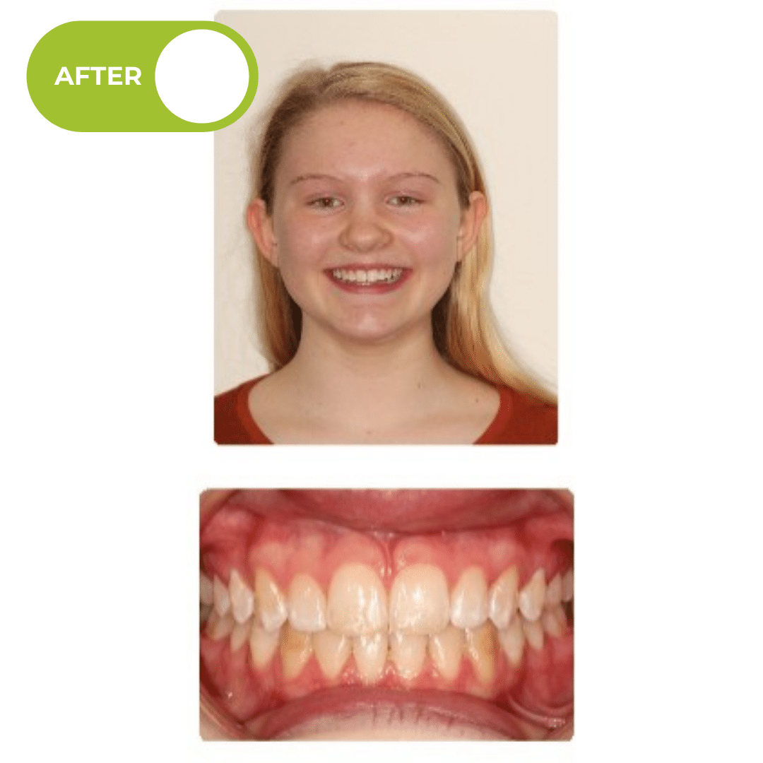 After orthodontic treatment showing improved bite alignment, better lower jaw position, and balanced facial profile after Herbst appliance and braces treatment. Advanced Orthodontics Mercer Island, located in Mercer Island, WA 98040.