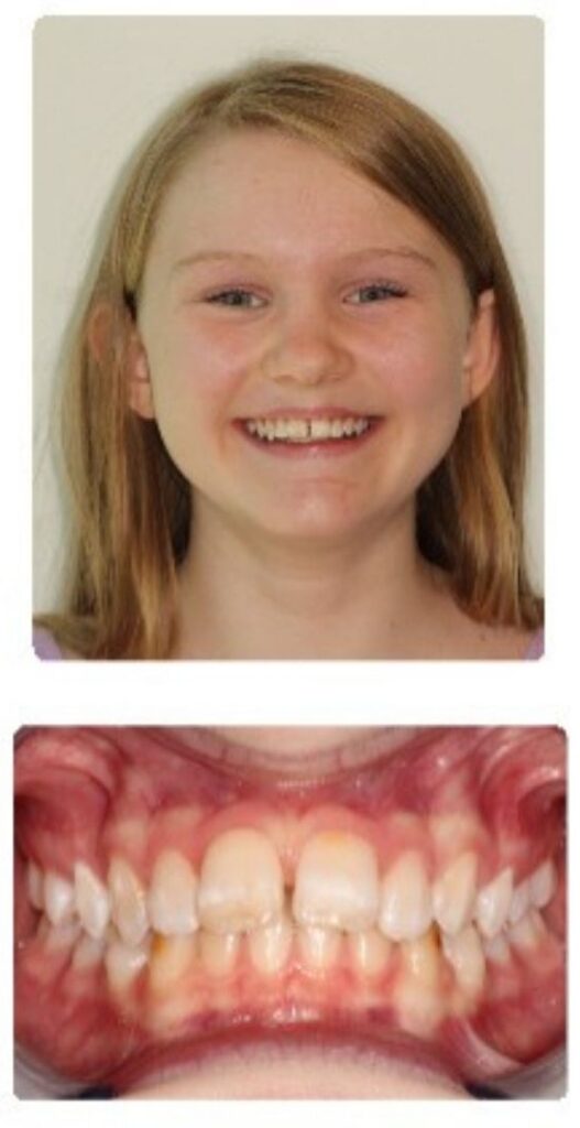 Before and after orthodontic treatment results at Advanced Orthodontics in Mercer Island, Washington