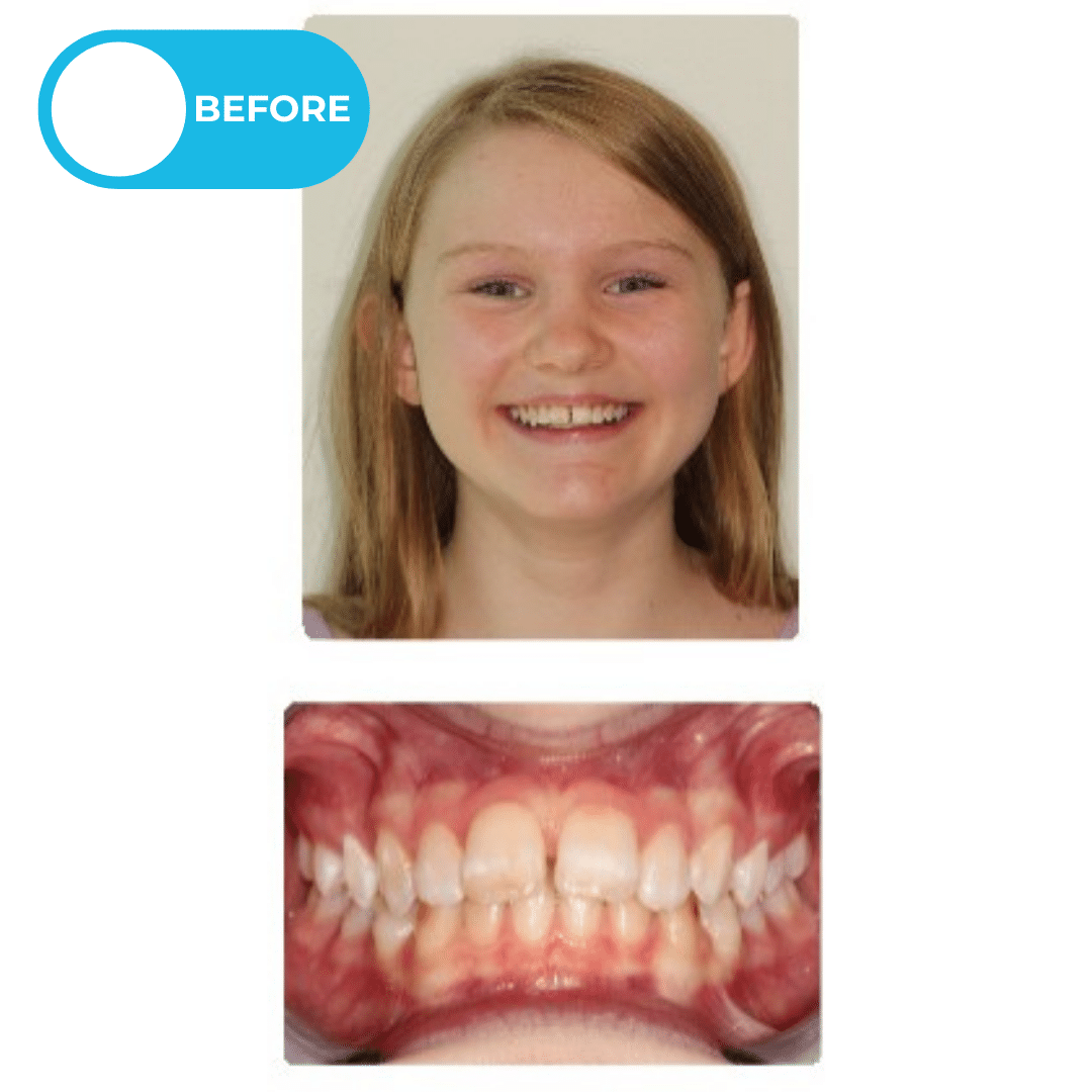 Before orthodontic treatment showing a patient with a severe overbite and a recessed lower jaw before Herbst appliance and braces treatment. Advanced Orthodontics Mercer Island, located in Mercer Island, WA 98040.