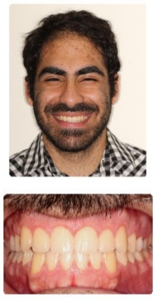 Before and after orthodontic treatment results at Advanced Orthodontics in Mercer Island, Washington