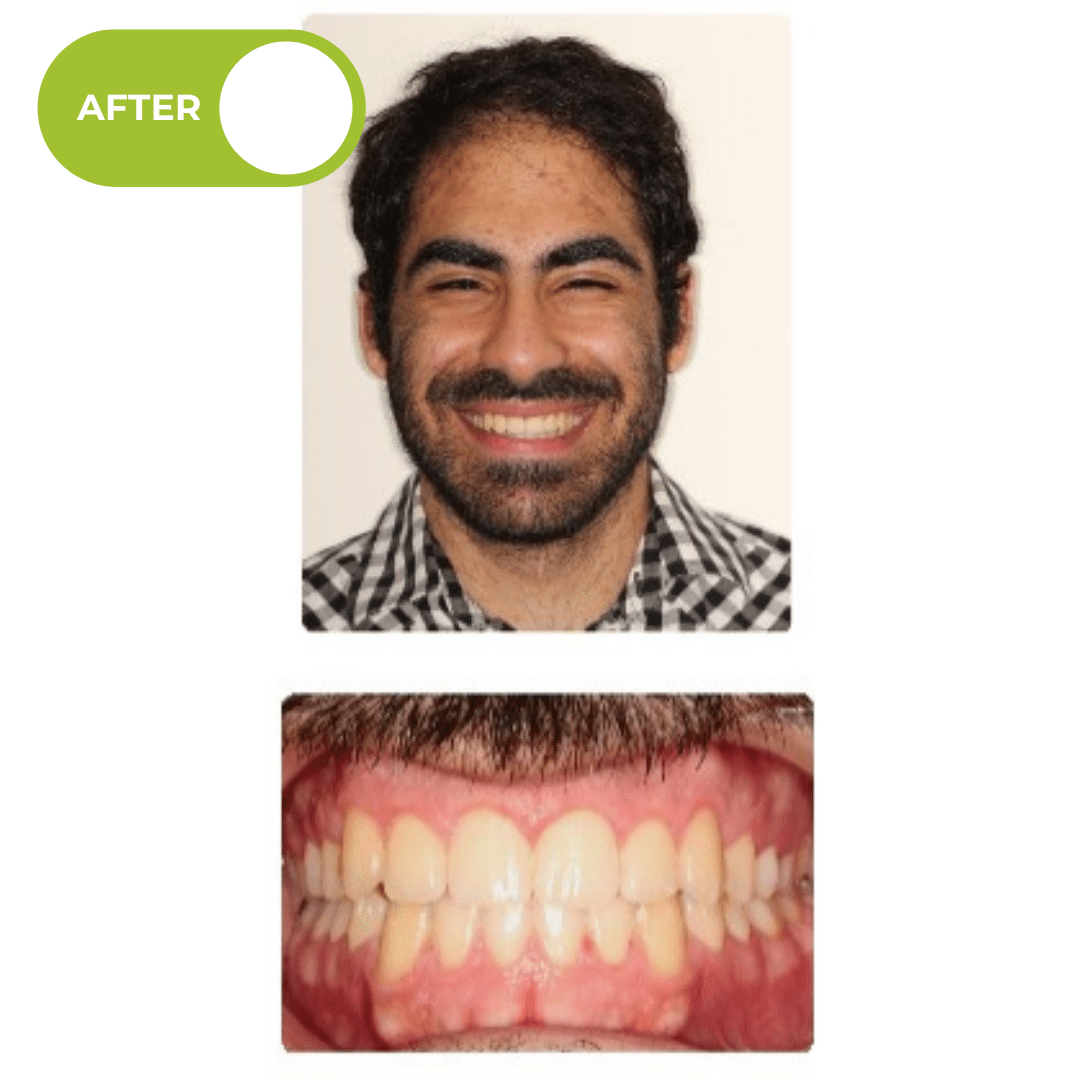 After orthodontic treatment showing improved overbite, balanced front tooth contact, and enhanced dental alignment after Invisalign clear aligner treatment. Advanced Orthodontics Mercer Island, located in Mercer Island, WA 98040.