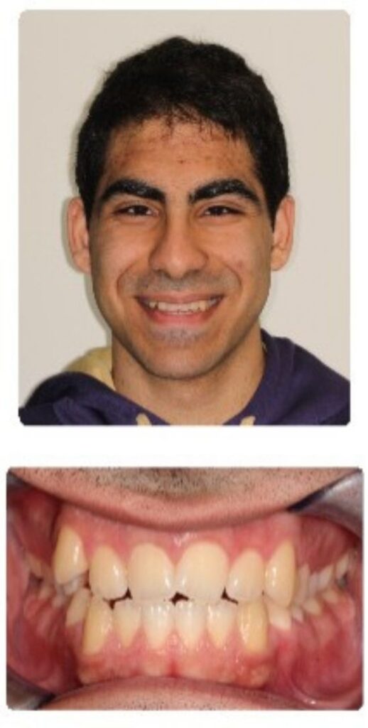 Before and after orthodontic treatment results at Advanced Orthodontics in Mercer Island, Washington