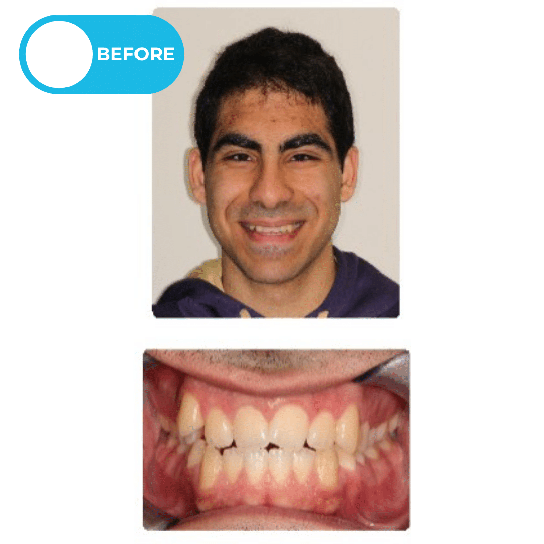 Before orthodontic treatment showing an adult patient with heavy front tooth contact and enamel wear before Invisalign clear aligner treatment. Advanced Orthodontics Mercer Island, located in Mercer Island, WA 98040.
