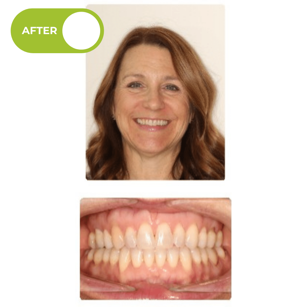 After orthodontic treatment showing a broader smile, improved dental spacing, and better overall alignment after Phase I treatment with a maxillary palatal expander and Invisalign aligners. Advanced Orthodontics Mercer Island, located in Mercer Island, WA 98040.