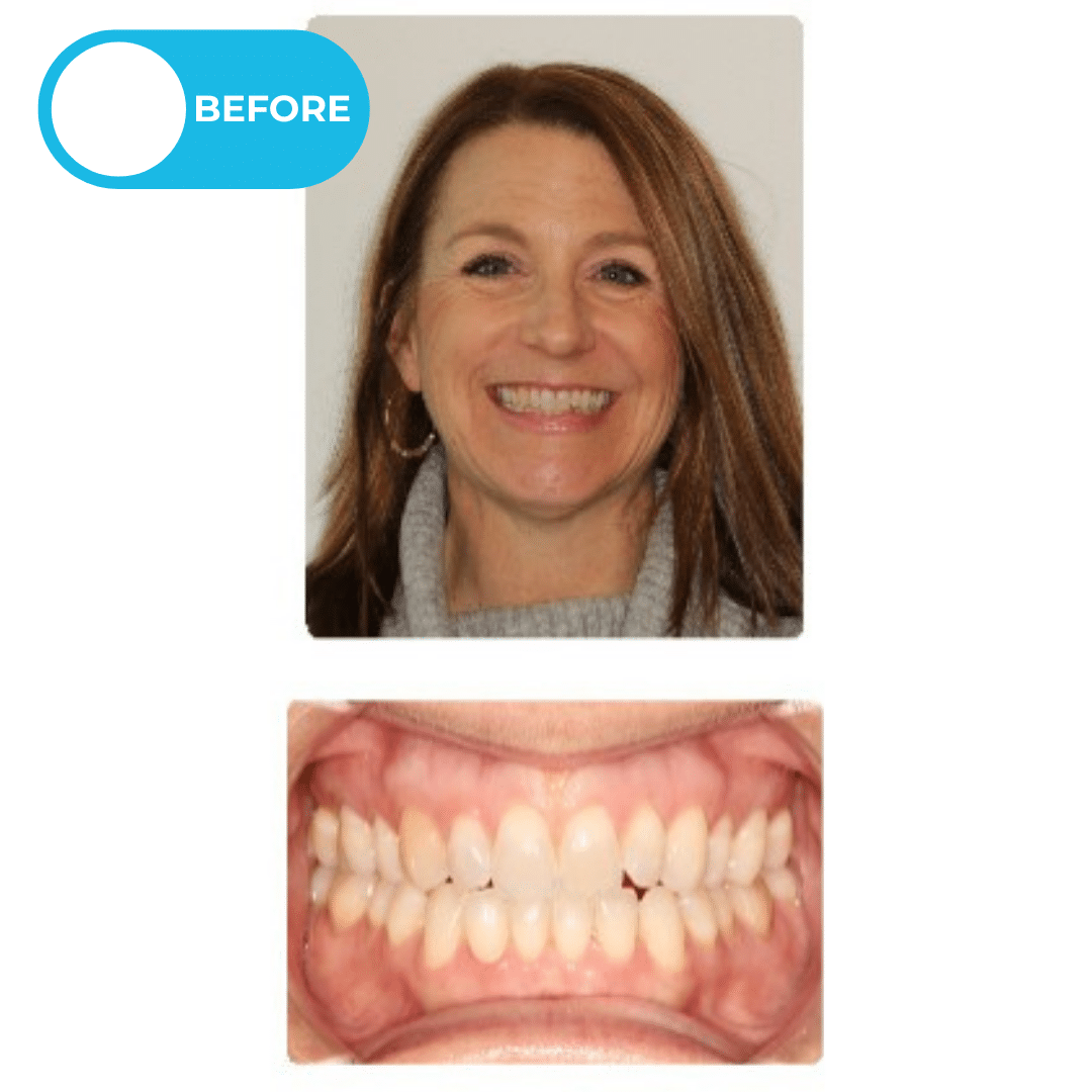 Before orthodontic treatment showing a patient with a narrow palate, severe dental crowding, and airway-related concerns before interceptive Phase I treatment with a maxillary palatal expander and Invisalign aligners. Advanced Orthodontics Mercer Island, located in Mercer Island, WA 98040.