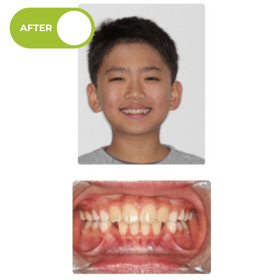 After orthodontic treatment showing improved overbite correction, reduced palate irritation, and better front tooth positioning after removable retainer and bite plate treatment. Advanced Orthodontics Mercer Island, located in Mercer Island, WA 98040.
