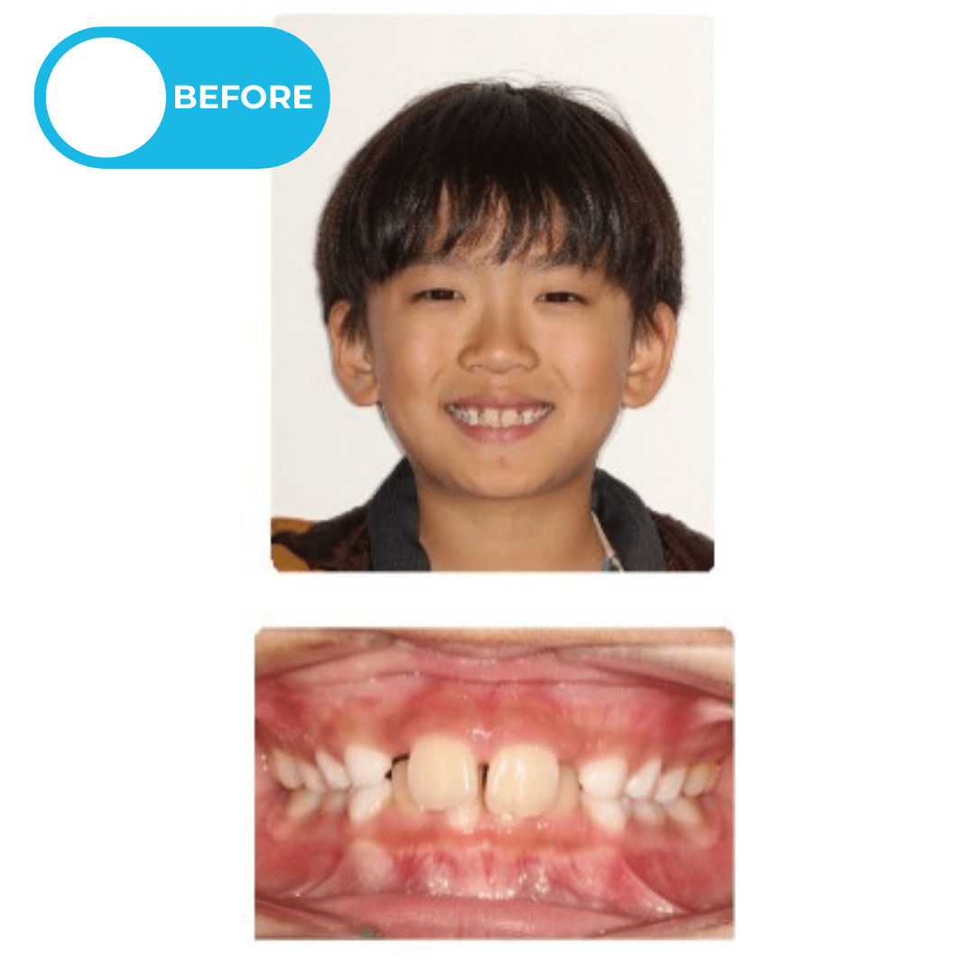 Before orthodontic treatment showing a young patient with a severe overbite and lower incisors contacting the palate before removable retainer and bite plate treatment. Advanced Orthodontics Mercer Island, located in Mercer Island, WA 98040.