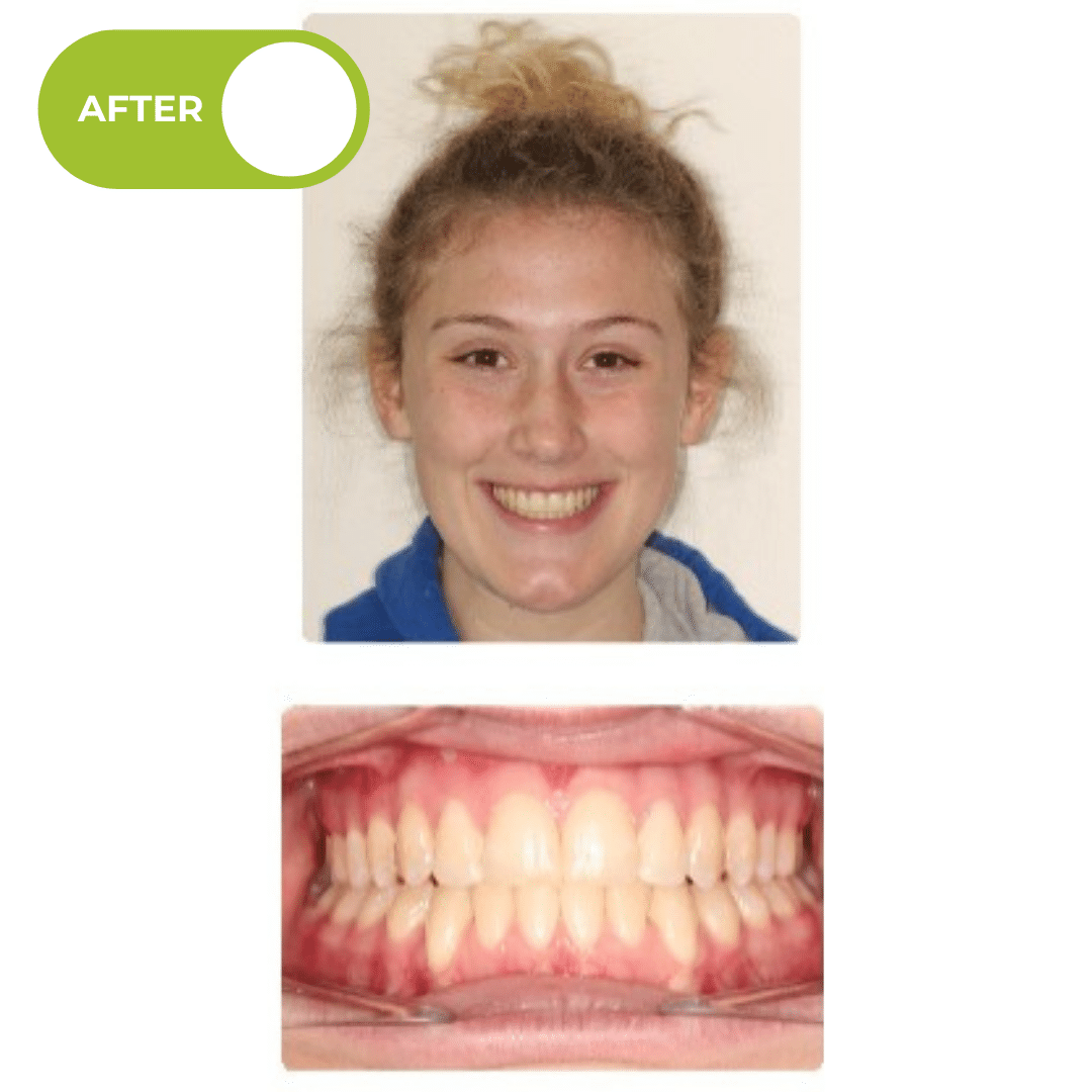After orthodontic treatment showing a broader smile, improved back tooth positioning, and better front tooth overlap after Invisalign clear aligner treatment. Advanced Orthodontics Mercer Island, located in Mercer Island, WA 98040.