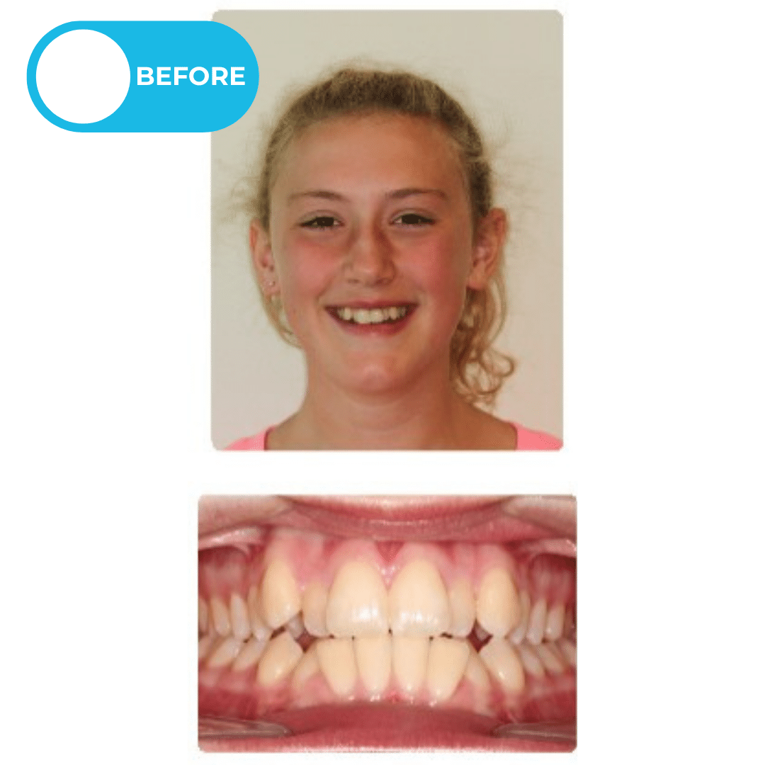 Before orthodontic treatment showing a patient with a narrow smile, inward-angled back teeth, and an overbite affecting front tooth function before Invisalign clear aligner treatment. Advanced Orthodontics Mercer Island, located in Mercer Island, WA 98040.