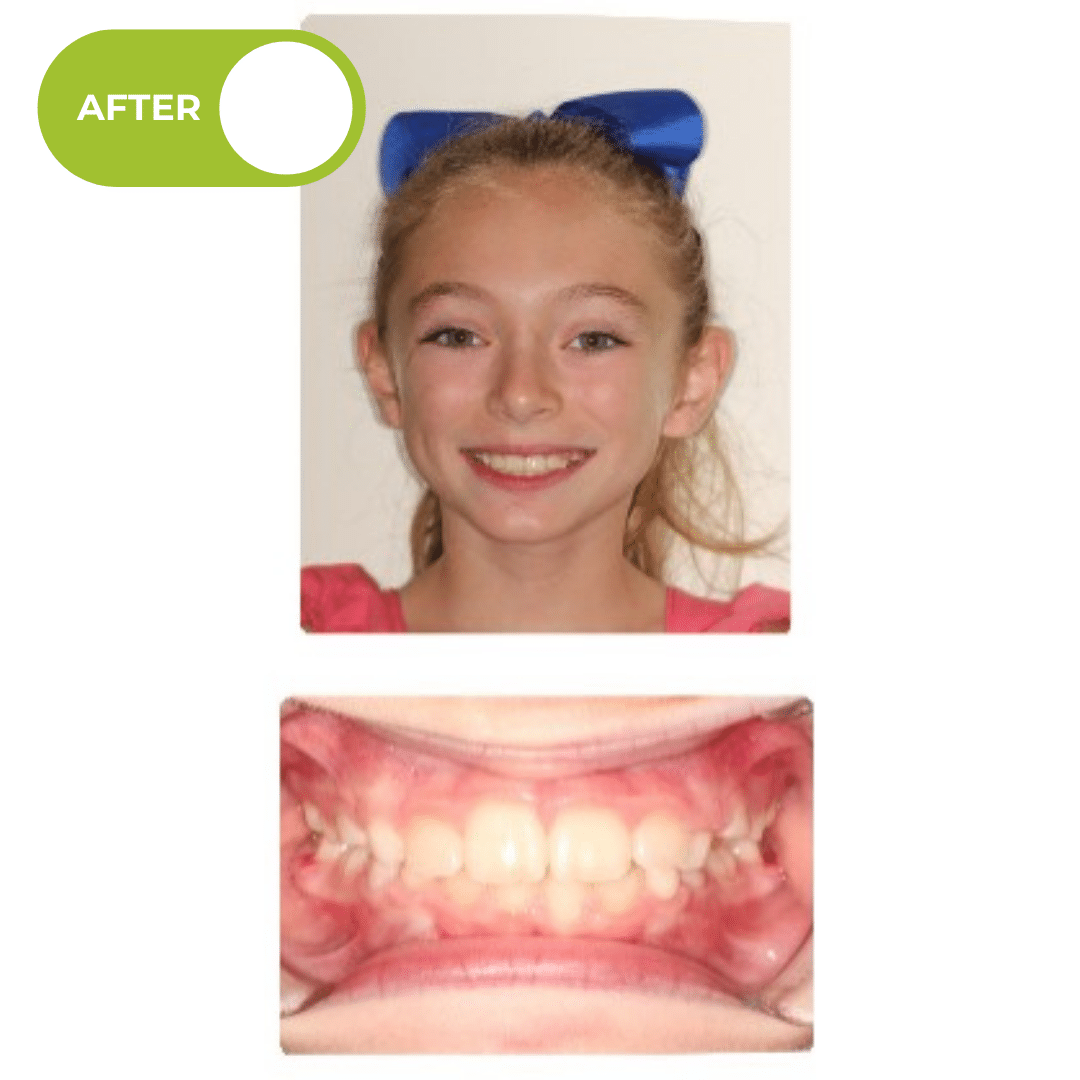 After orthodontic treatment showing a broader smile, improved overbite, and better front tooth overlap after clear braces and elastics treatment. Advanced Orthodontics Mercer Island, located in Mercer Island, WA 98040.