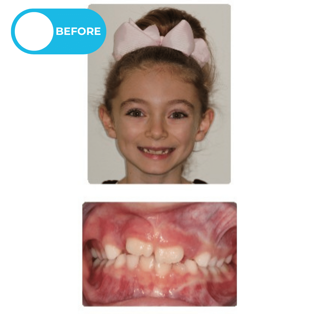Before orthodontic treatment showing a young patient with a narrow smile and minimal overbite with limited front tooth overlap before clear braces and elastics treatment. Advanced Orthodontics Mercer Island, located in Mercer Island, WA 98040.
