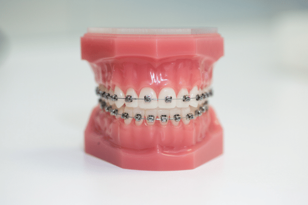 Metal and ceramic braces model showing orthodontic treatment at Advanced Orthodontics in Mercer Island, Washington